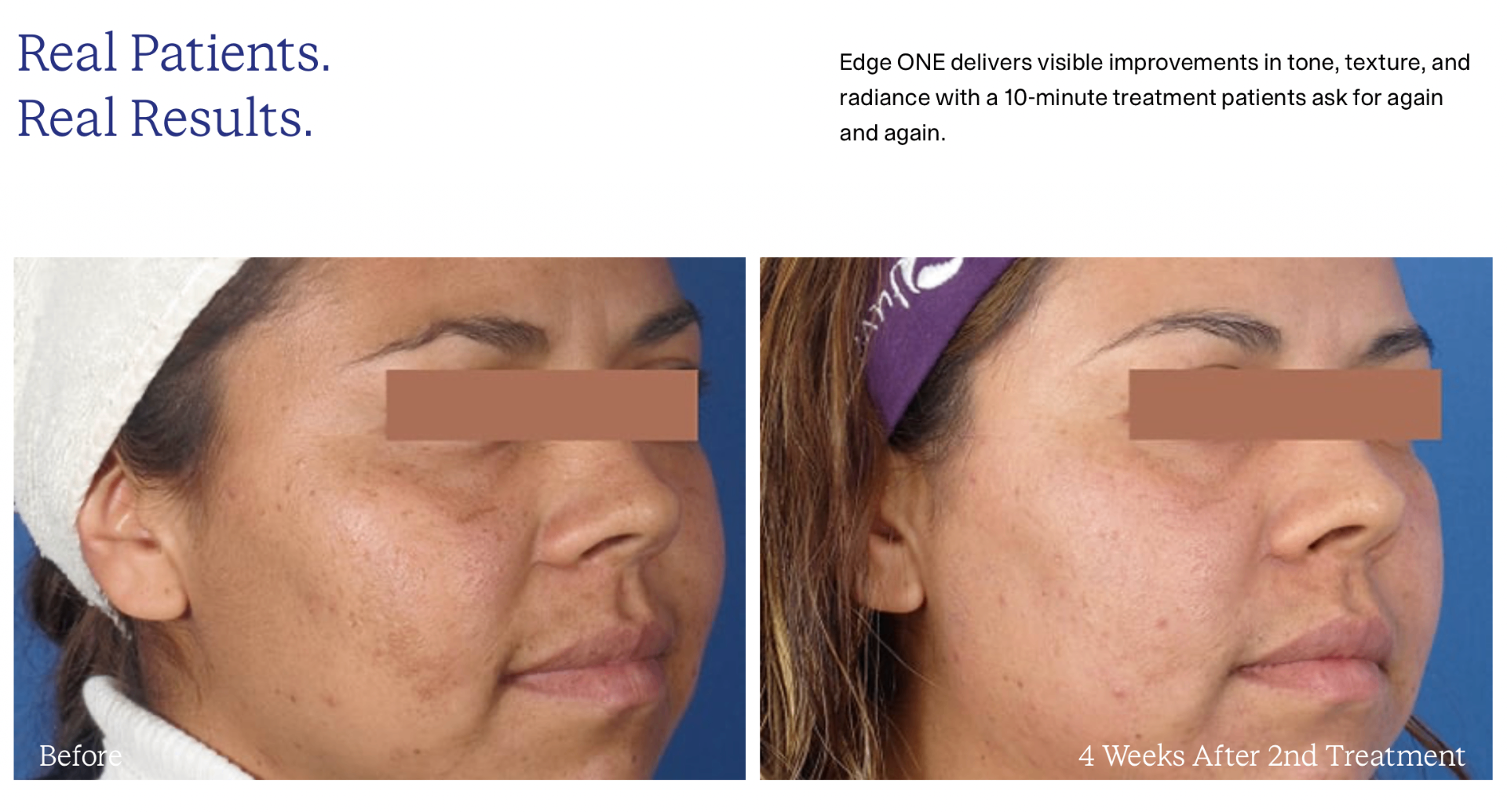 CO2 laser before and after Los Angeles — EdgeOne fractional CO2 resurfacing results at Beauty Ranch Brentwood