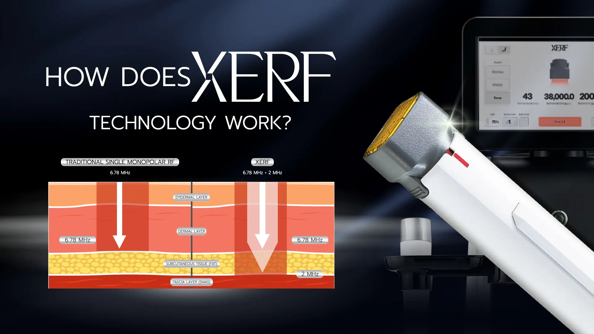XERF dual-frequency monopolar RF reaching dermis and SMAS layer for skin tightening