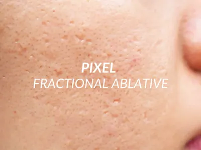 Pixel fractional ablative laser for acne scars at Beauty Ranch Brentwood