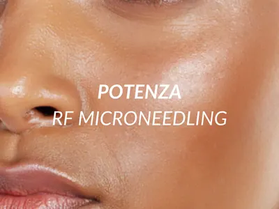 Potenza RF microneedling treatment for collagen stimulation at Beauty Ranch Los Angeles