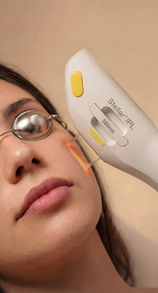 IPL photofacial laser treatment on patient at Beauty Ranch Medical Spa Los Angeles