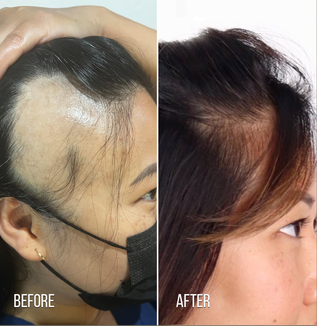 Alma TED needle-free hair restoration Brentwood Los Angeles — before and after a series of sessions