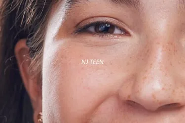 NJ Teen acne treatment facial program at Beauty Ranch Medical Spa