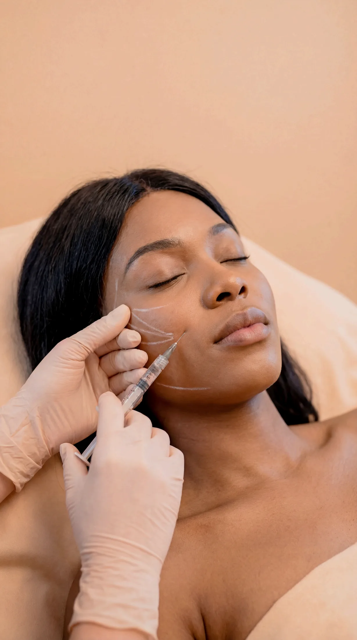 Sculptra treatment detail at Beauty Ranch Medical Spa
